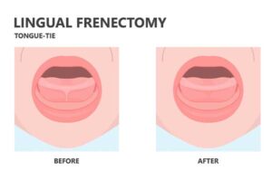 Lingual Frenectomy