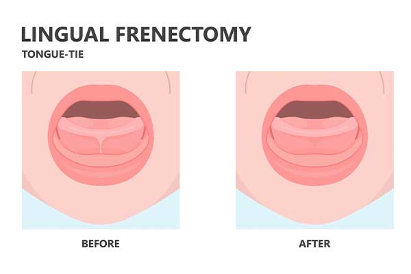 Lingual Frenectomy