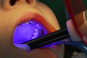 Needle-Free Fillings with Waterlase Laser Technology